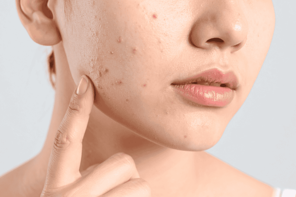 Skin Blemish Control